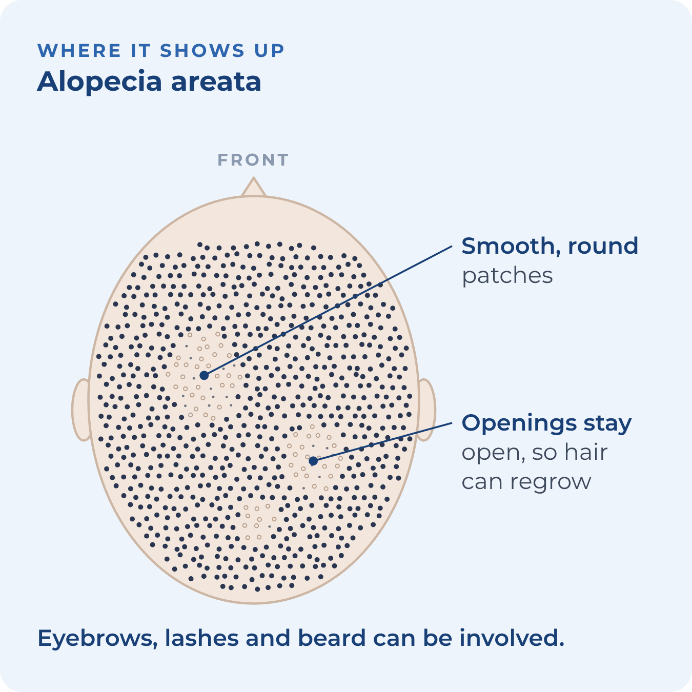 Top view of the scalp with smooth round patches of hair loss
