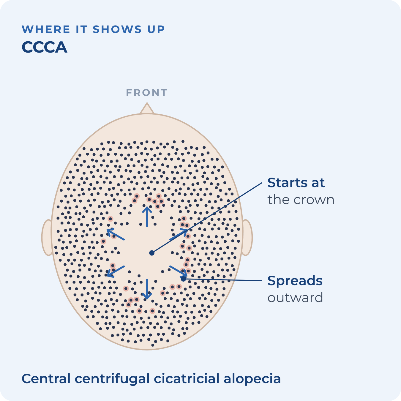Top view of the scalp with hair loss at the crown spreading outward