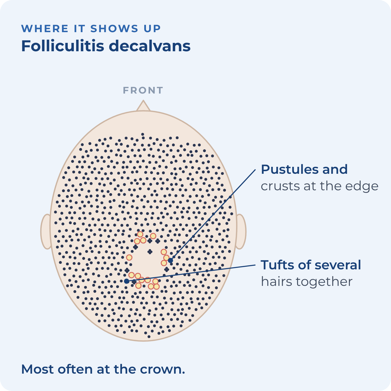 Top view of the scalp with a patch at the crown ringed by pustules and tufted hairs