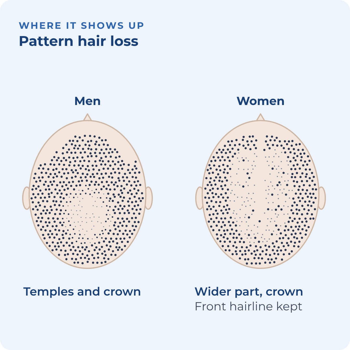 Two top views of the scalp: men lose hair at the temples and crown, women thin along the part and crown