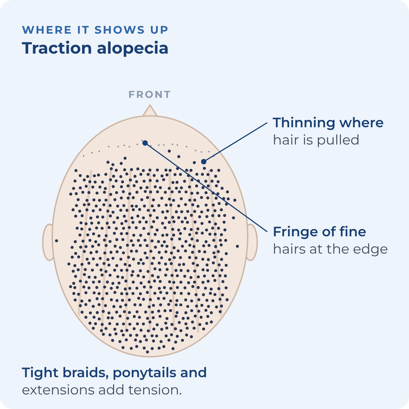 Top view of the scalp with thinning along the front and side hairline and a fringe of fine hairs