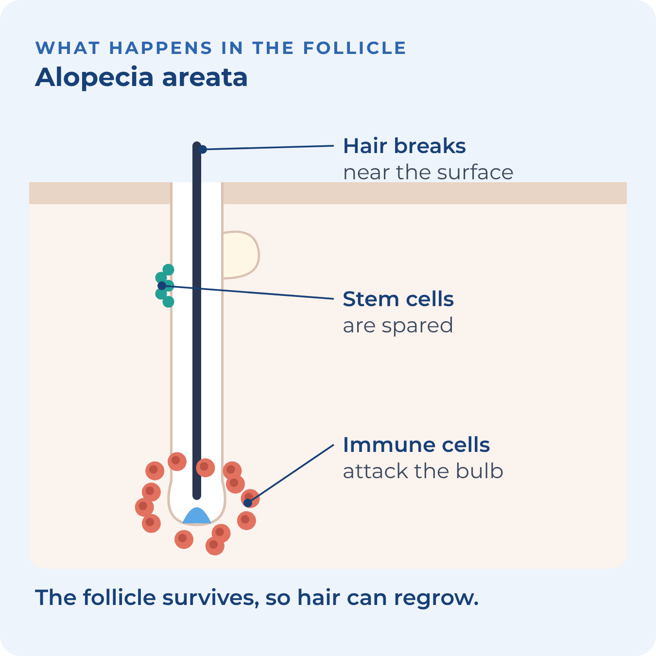 Immune cells gather around the hair bulb while the stem cells higher up are spared