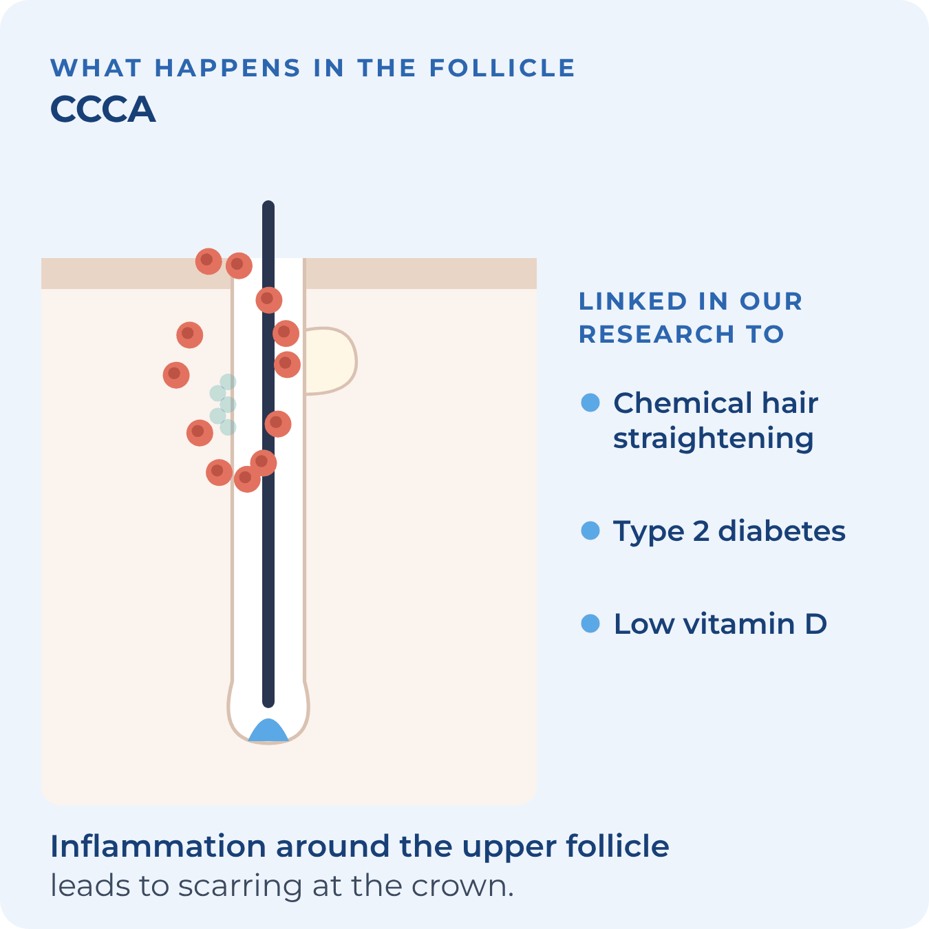 Immune cells around the upper follicle, with factors linked to CCCA in our research