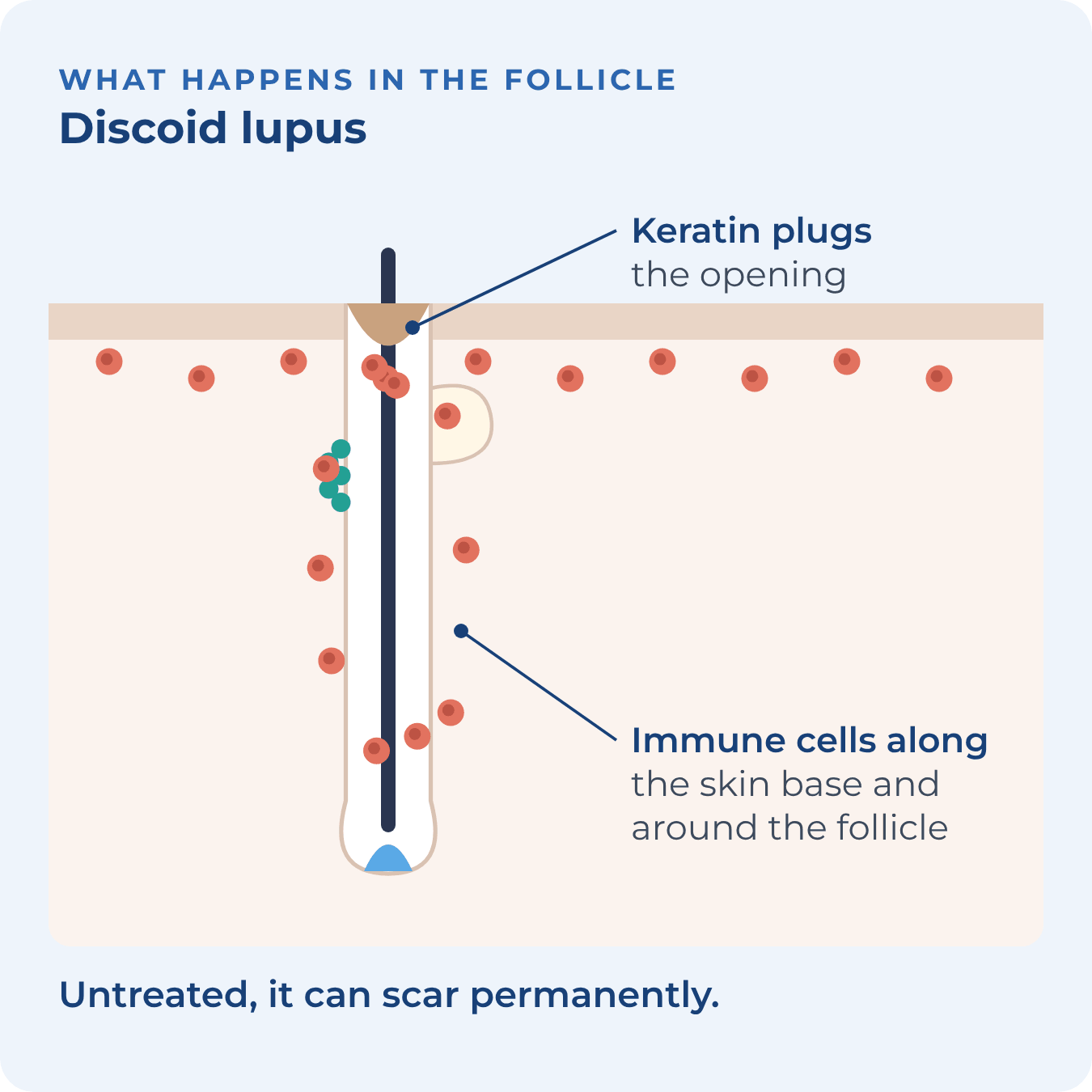 Immune cells along the base of the skin and around the follicle, with a keratin plug in the opening