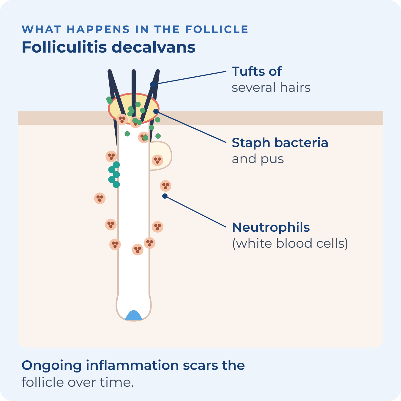 Staph bacteria and white blood cells around a follicle opening with several hairs growing from it