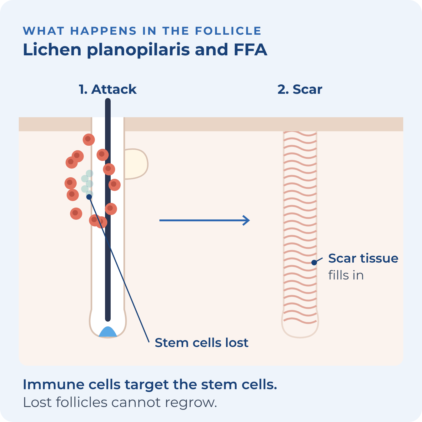 Immune cells attack the stem cells, then scar tissue fills in where the follicle was