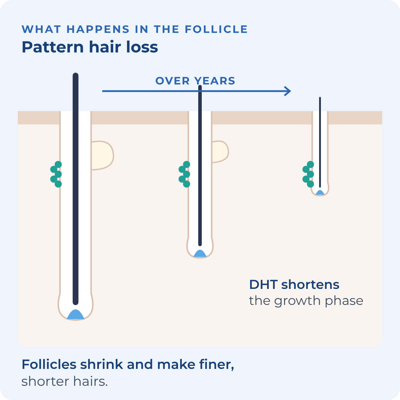 Three follicles getting smaller over time, each making a thinner hair
