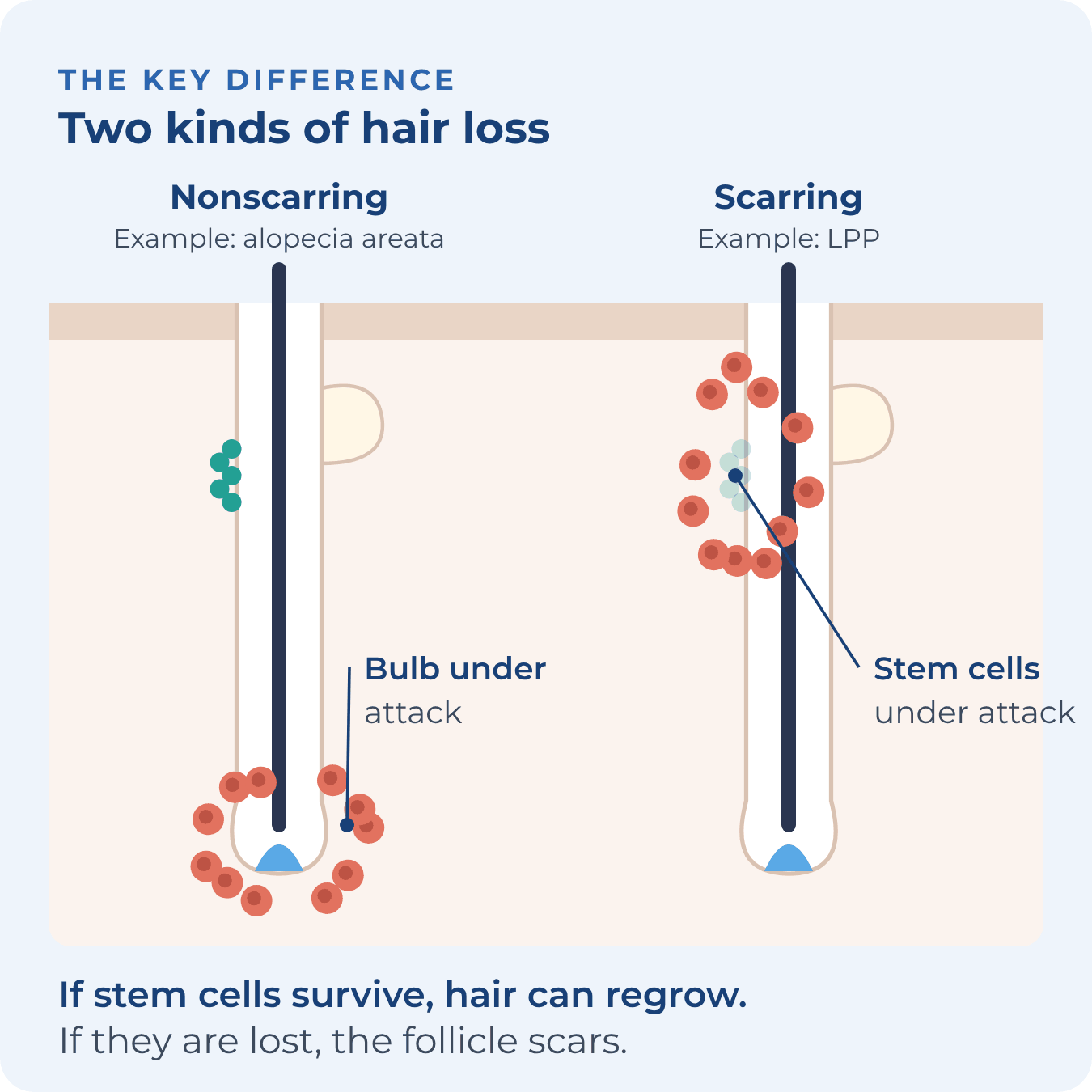Two follicles: in nonscarring hair loss immune cells attack the bulb and the stem cells survive; in scarring hair loss they attack the stem cells