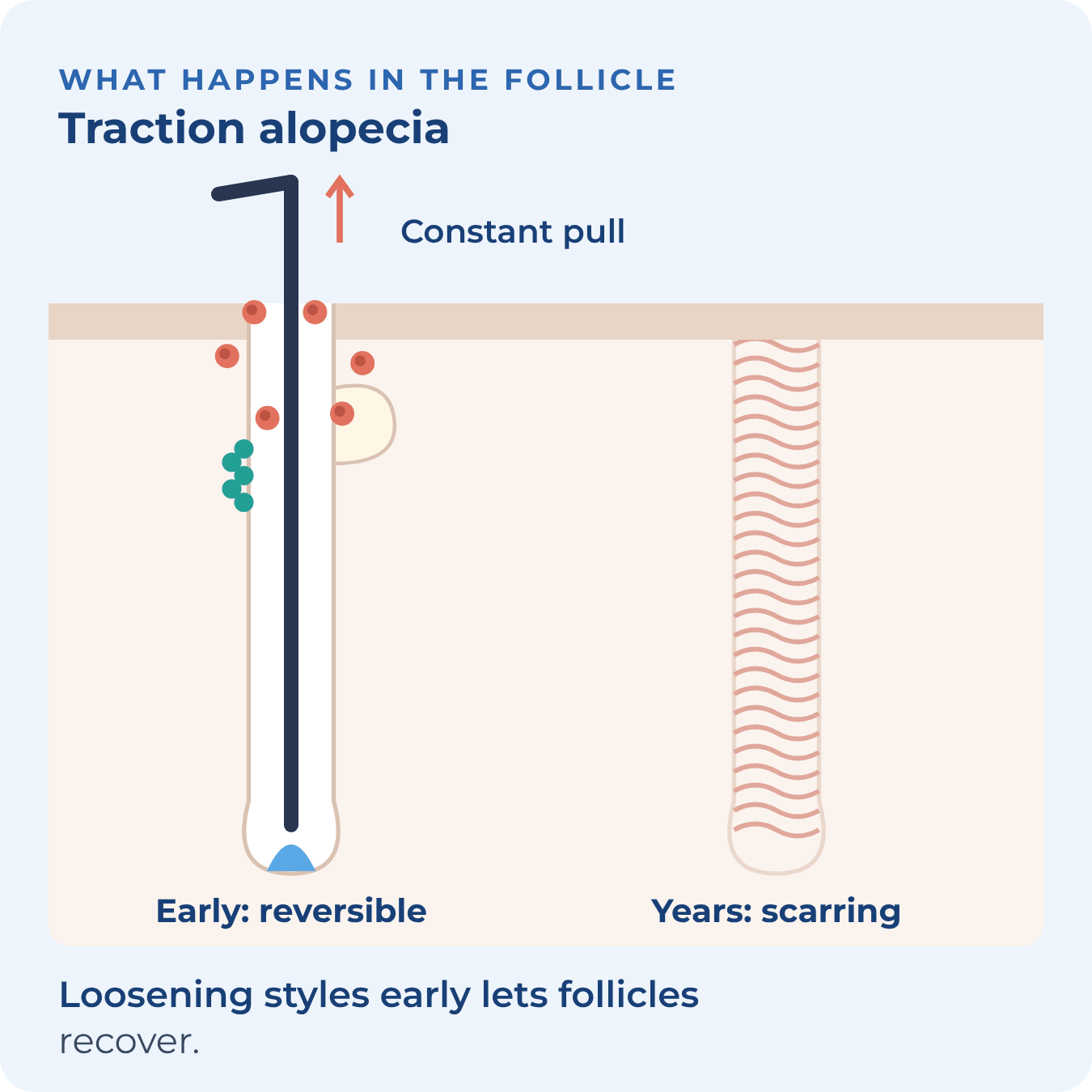A hair under constant pull irritates the follicle; years of tension can leave a scar